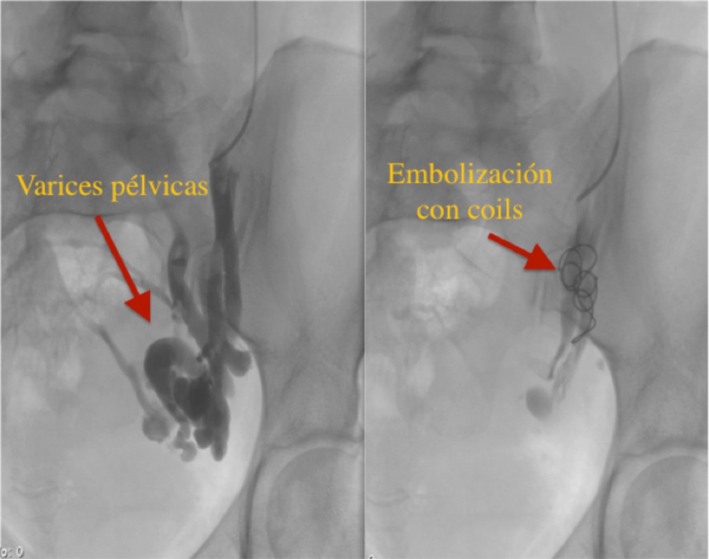 varicose pelvis într-un barbat