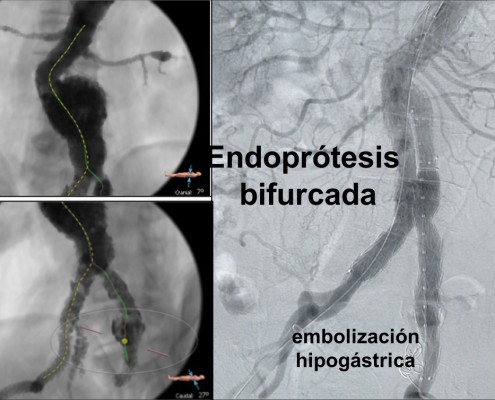 endoprótesis aorta