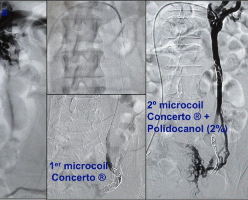 Trombosis venosa profunda iliofemoral. Síndrome de May Thurner